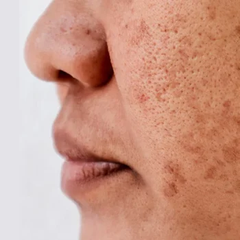 STUBBORN-PIGMENTATION-MARKS-BLEMISHES-550x460